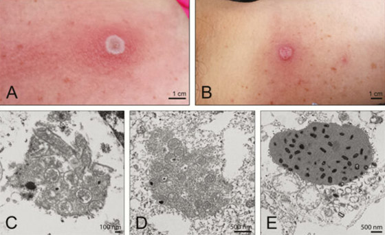 فيروس جديد يقتل أول مصاب به.. ماذا نعرف عن (جدري آلاسكا) ونصائح السلطات الصحية لتجنبه صورة رقم 7 فيروس جديد يقتل أول مصاب به.. ماذا نعرف عن (جدري آلاسكا) ونصائح السلطات الصحية لتجنبه صورة رقم 7