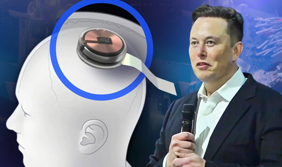 جديد شريحة ماسك المزروعة بالدماغ.. المريض حرك فأرة بمجرد التفكير صورة رقم 7