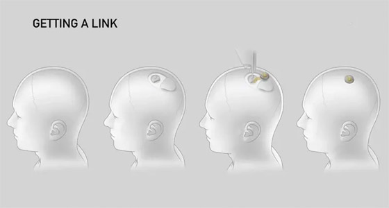 جديد شريحة ماسك المزروعة بالدماغ.. المريض حرك فأرة بمجرد التفكير صورة رقم 5