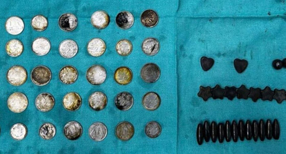 شاب يبتلع 37 مغناطيس و39 عملة معدنية ليبني عضلات! صور صورة رقم 2