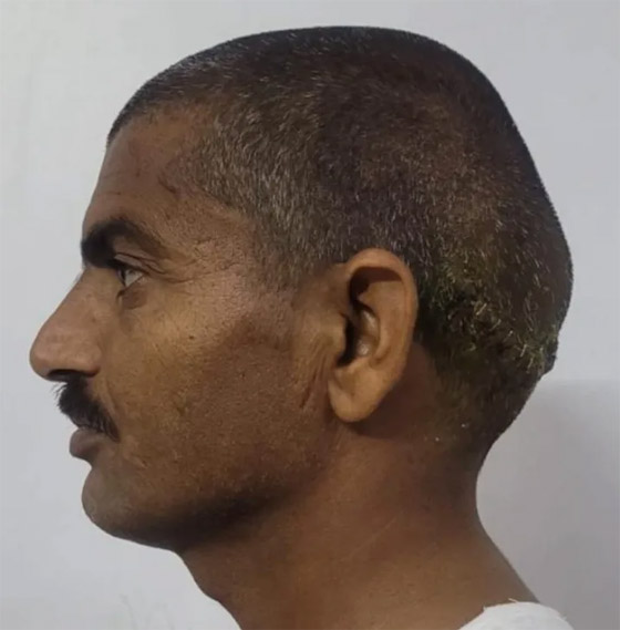 هندي عاش برأسين لمدة 15 عاما.. ما قصته؟ صورة رقم 3 هندي عاش برأسين لمدة 15 عاما.. ما قصته؟ صورة رقم 3