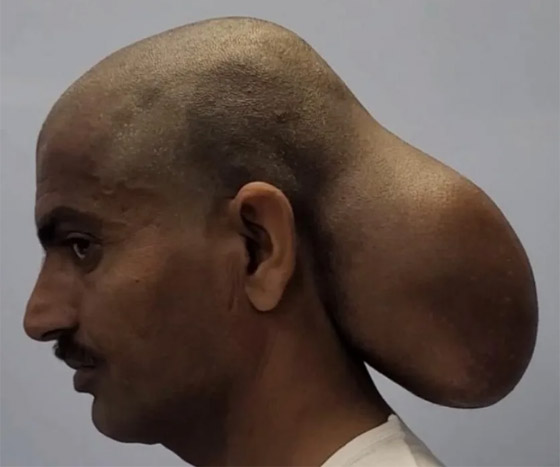 هندي عاش برأسين لمدة 15 عاما.. ما قصته؟ صورة رقم 2 هندي عاش برأسين لمدة 15 عاما.. ما قصته؟ صورة رقم 2