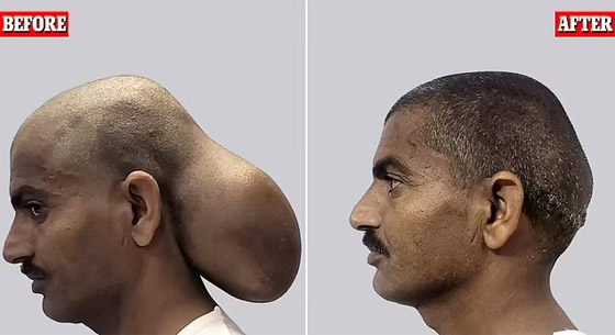 هندي عاش برأسين لمدة 15 عاما.. ما قصته؟ صورة رقم 1 هندي عاش برأسين لمدة 15 عاما.. ما قصته؟ صورة رقم 1