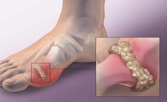 7 طرق لخفض حمض اليوريك في الجسم.. تعرف إليها صورة رقم 2