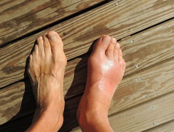 7 طرق لخفض حمض اليوريك في الجسم.. تعرف إليها صورة رقم 4