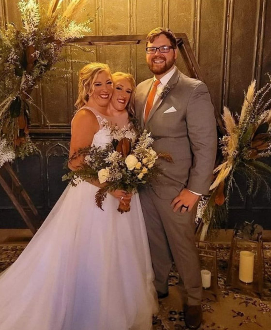 الكشف عن زواج أشهر توأم ملتصق في العالم صورة رقم 2