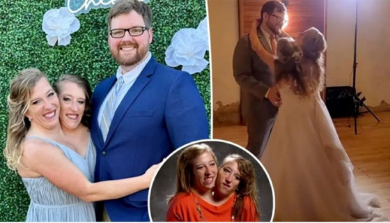 الكشف عن زواج أشهر توأم ملتصق في العالم صورة رقم 1