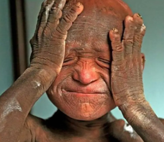 أخطر 10 أمراض يجب الحذر منها خلال سفرك المقبل صورة رقم 4