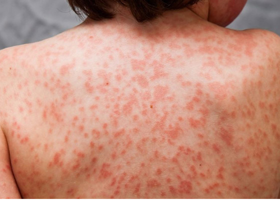 أخطر 10 أمراض يجب الحذر منها خلال سفرك المقبل صورة رقم 5