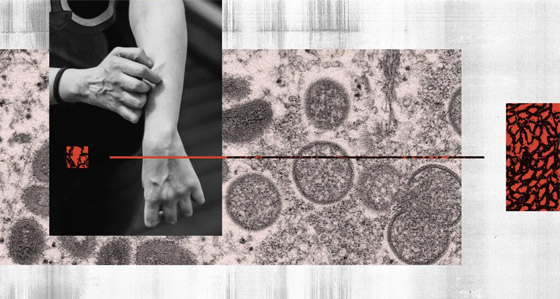 خطر وبائي.. اكتشاف سلالة متحورة من فيروس جدري القرود! صورة رقم 3