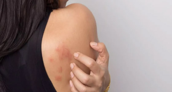 من التهاب الجهاز التنفسي إلى حساسية الجلد.. 4 أمراض قد تصيبك في الربيع صورة رقم 6