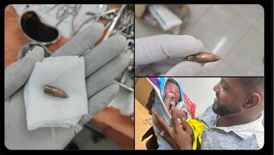 في وقت واحد.. توليد سودانية واستخراج رصاصة من رأسها صورة رقم 1