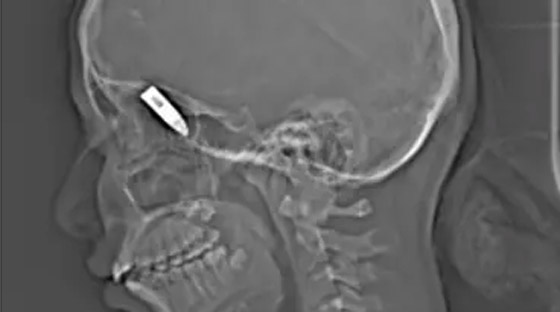 في وقت واحد.. توليد سودانية واستخراج رصاصة من رأسها صورة رقم 3