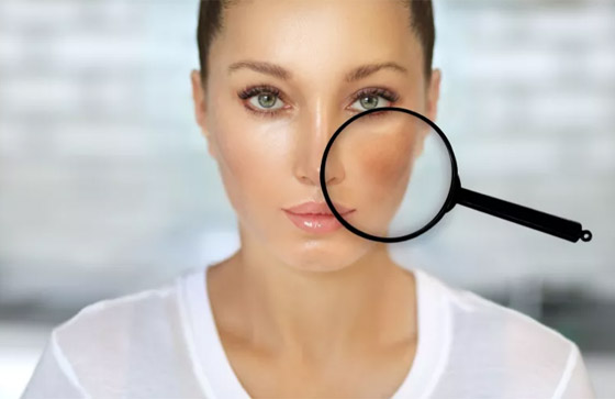 حيل للتخلص من البقع الصبغية على الوجه تغنيك عن العلاجات التجميلية صورة رقم 1