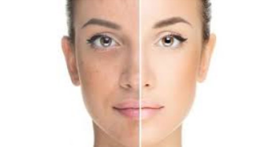 توحيد لون البشرة قبل الصيف.. إشراقة طبيعية وتوهج صورة رقم 3