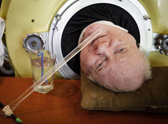 قصة ملهمة لرجل أمضى 70 عاما داخل “رئة حديدية” صورة رقم 3