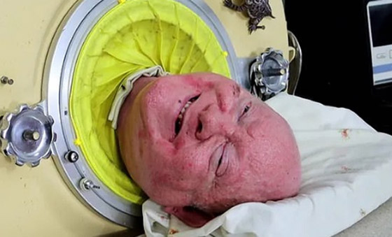 قصة ملهمة لرجل أمضى 70 عاما داخل “رئة حديدية” صورة رقم 5