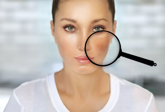 حيل للتخلص من البقع الصبغية على الوجه تغنيكم عن العلاجات التجميلية صورة رقم 1