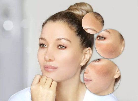 حيل للتخلص من البقع الصبغية على الوجه تغنيكم عن العلاجات التجميلية صورة رقم 2