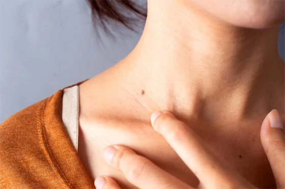 في شهر التوعية بسرطان الجلد..7 نصائح تقي من الإصابة صورة رقم 5