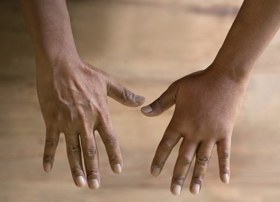 منها تغير درجات الحرارة.. 8 أسباب تؤدي إلى تورم اليدين المفاجئ صورة رقم 2