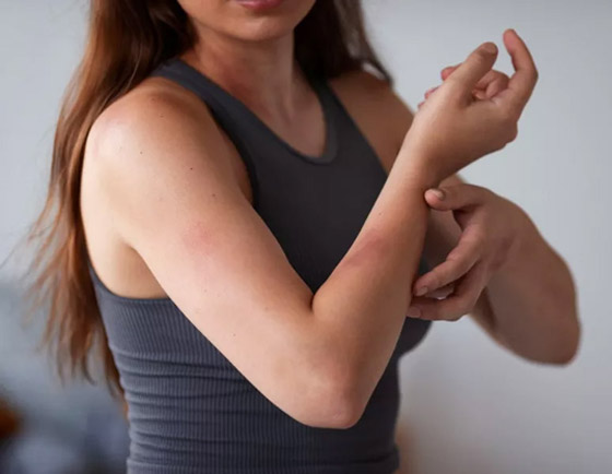 أسباب ظهور البقع الزرقاء على الجلد ومتى تكون خطيرة صورة رقم 1