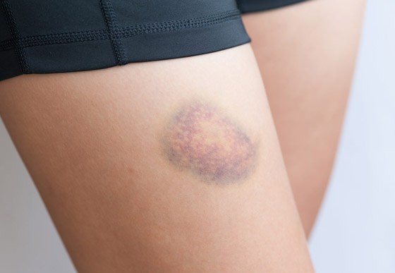 أسباب ظهور البقع الزرقاء على الجلد ومتى تكون خطيرة صورة رقم 4