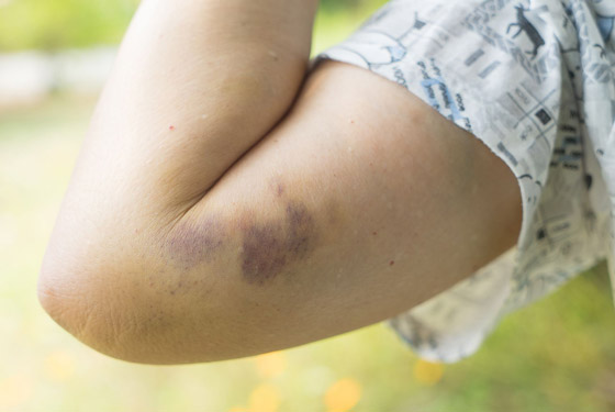 أسباب ظهور البقع الزرقاء على الجلد ومتى تكون خطيرة صورة رقم 3