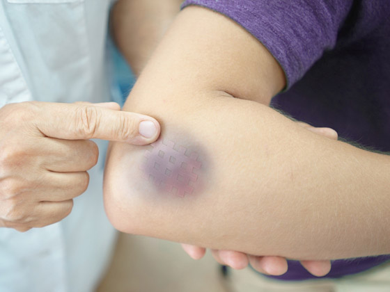 أسباب ظهور البقع الزرقاء على الجلد ومتى تكون خطيرة صورة رقم 5