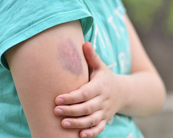 أسباب ظهور البقع الزرقاء على الجلد ومتى تكون خطيرة صورة رقم 6