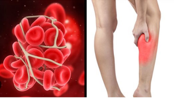 أبرز مسببات الجلطات.. عادات تمارسها يوميا اعرفها صورة رقم 3