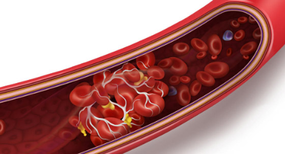 أبرز مسببات الجلطات.. عادات تمارسها يوميا اعرفها صورة رقم 4