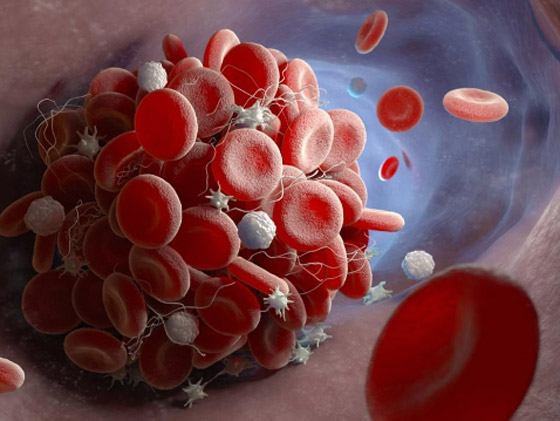 أبرز مسببات الجلطات.. عادات تمارسها يوميا اعرفها صورة رقم 5