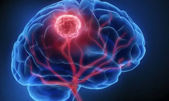 5 علامات تشير لوجود ورم في المخ قد تفاجئك.. منها التعثر أثناء المشى صورة رقم 4