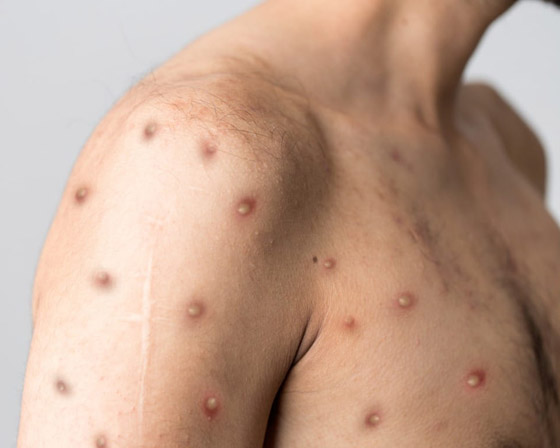 ما الفرق بين جدري القردة وفيروس كورونا.. هل يمكن أن يتحول لجائحة؟ صورة رقم 10