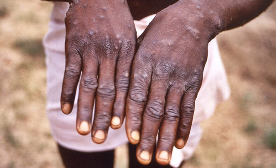 ما الفرق بين جدري القردة وفيروس كورونا.. هل يمكن أن يتحول لجائحة؟ صورة رقم 13