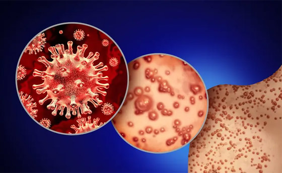 ما الفرق بين جدري القردة وفيروس كورونا.. هل يمكن أن يتحول لجائحة؟ صورة رقم 5