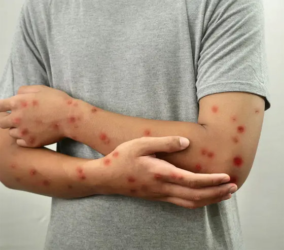 ما الفرق بين جدري القردة وفيروس كورونا.. هل يمكن أن يتحول لجائحة؟ صورة رقم 4