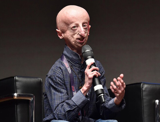 عن 28 عاما.. وفاة المصاب بالشيخوخة المبكرة الأطول عمرا صورة رقم 4