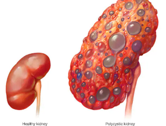 5 علامات غير عادية لتلف الكلى.. لا تتجاهلها صورة رقم 2