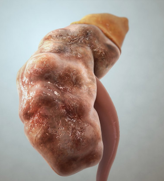 5 علامات غير عادية لتلف الكلى.. لا تتجاهلها صورة رقم 4