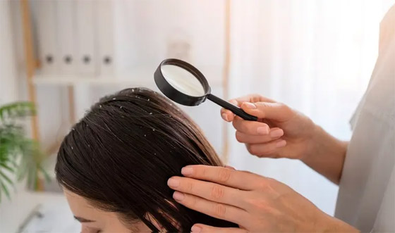 11 وصفة منزلية فعالة في القضاء نهائيا على قشرة الشعر صورة رقم 1