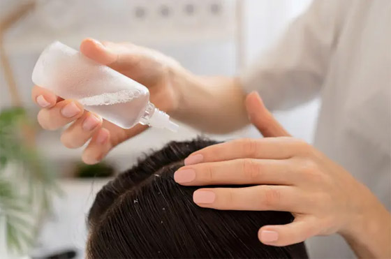 11 وصفة منزلية فعالة في القضاء نهائيا على قشرة الشعر صورة رقم 2