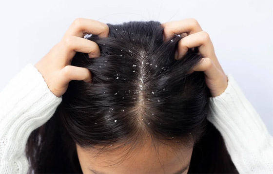 11 وصفة منزلية فعالة في القضاء نهائيا على قشرة الشعر صورة رقم 5