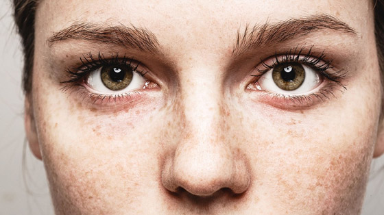 تزعجكِ زيادة النمش؟.. إليكِ أفضل العلاجات صورة رقم 1