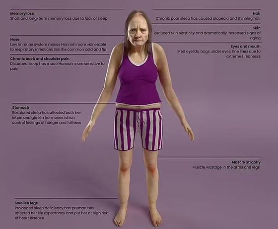 صور مرعبة.. هكذا سنبدو إذا نمنا 6 ساعات فقط! صورة رقم 1 صور مرعبة.. هكذا سنبدو إذا نمنا 6 ساعات فقط! صورة رقم 1