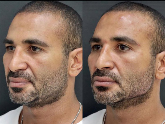 قصة 5 فنانين مع عمليات التجميل: وليد توفيق يجريها باستمرار وراغب علامة لجأ لـ بوتوكس صورة رقم 1