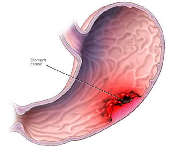 علامات غير شائعة لسرطان المعدة.. منها التعب الشديد صورة رقم 1