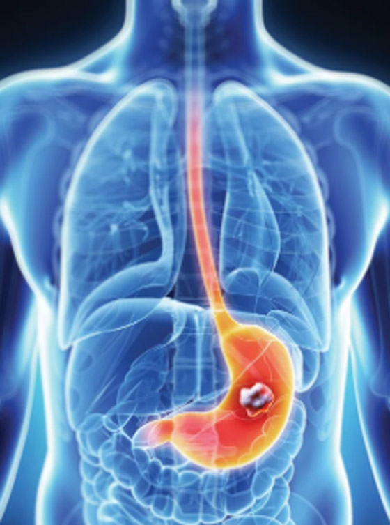 علامات غير شائعة لسرطان المعدة.. منها التعب الشديد صورة رقم 2