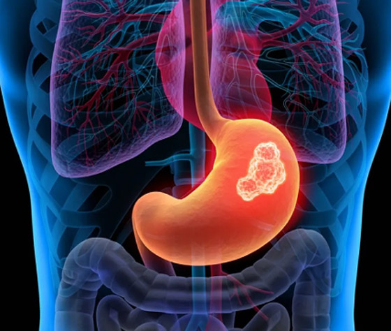 علامات غير شائعة لسرطان المعدة.. منها التعب الشديد صورة رقم 3